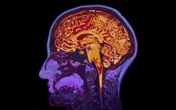 MRI-Beeld die van Hoofd Hersenen tonen MRI-Beeld die van Hoofd Hersenen tonen