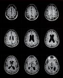 Mri of brain showing multiple sclerosis