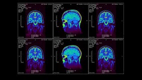 MRI of the brain in three dimensions, video loop, alpha-channel