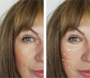 A mulher adulta enruga-se antes do tratamento do esteticista dos resultados que levanta após os procedimentos da medicina dos res imagem de stock royalty free A mulher adulta enruga-se antes do tratamento do esteticista dos resultados que levanta após os procedimentos da medicina dos res imagem de stock royalty free