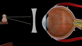 Myopia wklęsły obiektyw Myopia wklęsły obiektyw