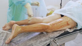 A m?o ascendente pr?xima da enfermeira desinfeta o p? paciente antes da cirurgia da veia varicosa na sala de opera? A m?o ascendente pr?xima da enfermeira desinfeta o p? paciente antes da cirurgia da veia varicosa na sala de opera?
