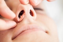 Nasal hair-removal with hot wax Stock Photography Nasal hair-removal with hot wax Stock Photography