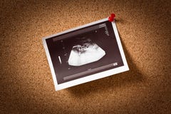 New life on ultrasound image