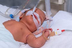 Nyfött behandla som ett barn med hyperbilirubinemia på andningmaskinen med pulsoximeteravkännaren i neonatal intensivvårdenhet på royaltyfri foto Nyfött behandla som ett barn med hyperbilirubinemia på andningmaskinen med pulsoximeteravkännaren i neonatal intensivvårdenhet på royaltyfri foto