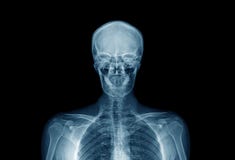 oberer Teil des menschlichen Körpers, Höhenqualitäts-Röntgenstrahlbild von menschlichem herein lizenzfreies stockbild oberer Teil des menschlichen Körpers, Höhenqualitäts-Röntgenstrahlbild von menschlichem herein lizenzfreies stockbild