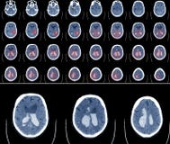 Obliczający tomografii CT obraz cyfrowy mózg zdjęcie stock Obliczający tomografii CT obraz cyfrowy mózg zdjęcie stock