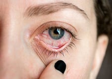 Onjunctivitis Ð ¡ pinkeye Μάτι γυναικών ` s Ασθένεια ματιών Κλειστός επάνω στοκ φωτογραφία με δικαίωμα ελεύθερης χρήσης Onjunctivitis Ð ¡ pinkeye Μάτι γυναικών ` s Ασθένεια ματιών Κλειστός επάνω στοκ φωτογραφία με δικαίωμα ελεύθερης χρήσης