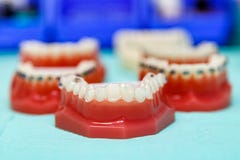 Orthodontic αόρατα και στηρίγματα καλωδίων στοκ φωτογραφίες με δικαίωμα ελεύθερης χρήσης Orthodontic αόρατα και στηρίγματα καλωδίων στοκ φωτογραφίες με δικαίωμα ελεύθερης χρήσης