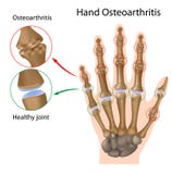 Osteoartrite della mano illustrazione vettoriale Osteoartrite della mano illustrazione vettoriale