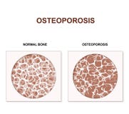 osteoporose vector illustratie osteoporose vector illustratie