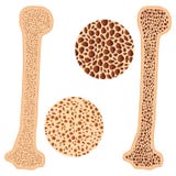 Osteoporosis bone and healthy bone. vector illustration Osteoporosis bone and healthy bone. vector illustration