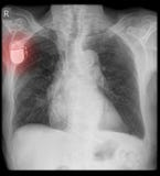 Pacemaker on x-ray with wire