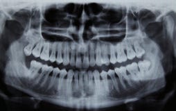 Panoramiczny stomatologiczny Xray obrazy royalty free Panoramiczny stomatologiczny Xray obrazy royalty free