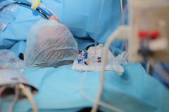 Patient sur la table pendant la chirurgie Images libres de droits Patient sur la table pendant la chirurgie Images libres de droits