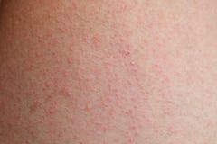 Farmaci per giunture a psoriasi