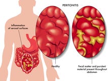 Peritonitis stock photography Peritonitis stock photography