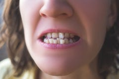 Photo Of Crooked Woman Teeth Stock Image