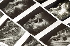 Photo shots of Medical ultrasound, diagnostic sonography or ultrasonography of foliculometry in the protocol of the ivf program