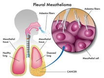 Pleural mesothelioma stock illustration Pleural mesothelioma stock illustration