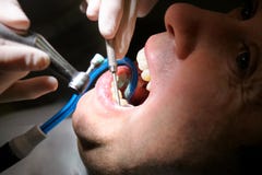 Polissage dentaire de dent Dents nettoyant, hygiène dentaire Le dentiste est polissage des dents patientes avec la brosse dentair image libre de droits Polissage dentaire de dent Dents nettoyant, hygiène dentaire Le dentiste est polissage des dents patientes avec la brosse dentair image libre de droits