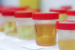 Preparação de amostras de urina no laboratório no hospital para o estudo Tiras de teste especiais para o exame da urina foto de stock Preparação de amostras de urina no laboratório no hospital para o estudo Tiras de teste especiais para o exame da urina foto de stock