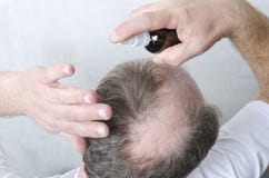 Procedimiento de la belleza para el crecimiento del pelo El hombre tiene un problema con pérdida de pelo foto de archivo libre de regalías Procedimiento de la belleza para el crecimiento del pelo El hombre tiene un problema con pérdida de pelo foto de archivo libre de regalías