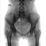 Promieniowanie rentgenowskie pelvis i lumbosacral kręgosłup Spina bifida S1 negatyw markiery zdjęcie royalty free Promieniowanie rentgenowskie pelvis i lumbosacral kręgosłup Spina bifida S1 negatyw markiery zdjęcie royalty free