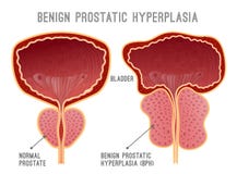 Prostate Ziekte Infographic stock illustratie Prostate Ziekte Infographic stock illustratie