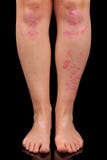 Psoriasis Psoriasis