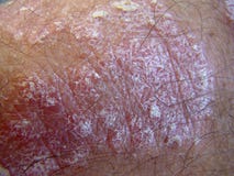 Psoriasis stock photography Psoriasis stock photography