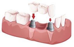 Puente dental stock de ilustración Puente dental stock de ilustración