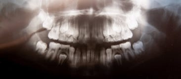 Radiografía dental panorámica de la foto del niño con los dientes de leche y los primeros dientes molares Foco selectivo Atención foto de archivo libre de regalías Radiografía dental panorámica de la foto del niño con los dientes de leche y los primeros dientes molares Foco selectivo Atención foto de archivo libre de regalías