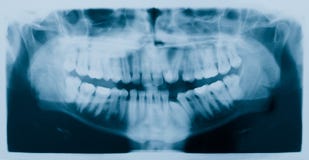 Radiografía dental (radiografía) Radiografía dental (radiografía)