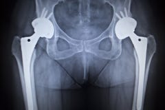 Radiologiczny obrazu cyfrowego wizerunek modnego złącza zastępstwa ortopedyczny wszczep zdjęcia royalty free Radiologiczny obrazu cyfrowego wizerunek modnego złącza zastępstwa ortopedyczny wszczep zdjęcia royalty free