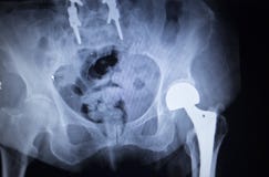 Radiologiczny obrazu cyfrowego wizerunek modnego złącza zastępstwa ortopedyczny wszczep zdjęcie royalty free Radiologiczny obrazu cyfrowego wizerunek modnego złącza zastępstwa ortopedyczny wszczep zdjęcie royalty free