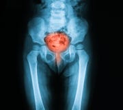 Radiologiczny wizerunek Miednicowy, supinum widok zdjęcie stock Radiologiczny wizerunek Miednicowy, supinum widok zdjęcie stock