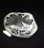 Radiologisk patologi för anatomi för mriexamenhandled arkivfoto Radiologisk patologi för anatomi för mriexamenhandled arkivfoto