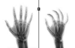 Raio X da mão Fratura do ó osso metacarpal a criança Negativo fotografia de stock royalty free Raio X da mão Fratura do ó osso metacarpal a criança Negativo fotografia de stock royalty free