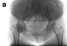Rayon X du bassin Déformer l'arthrose de l'articulation de la hanche droite Nécrose aseptique de la tête fémorale Négatif images libres de droits Rayon X du bassin Déformer l'arthrose de l'articulation de la hanche droite Nécrose aseptique de la tête fémorale Négatif images libres de droits