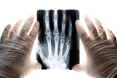 Rayon X tiré de la main dans les mains du docteur dans les gants blancs Fracture de concept du doigt et du déplacement des joints images libres de droits Rayon X tiré de la main dans les mains du docteur dans les gants blancs Fracture de concept du doigt et du déplacement des joints images libres de droits