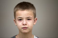 Retrato da crian?a triste doente do menino que sofre do sarampo ou da catapora com colis?es por todo o lado na cara Doen?as conta foto de stock Retrato da crian?a triste doente do menino que sofre do sarampo ou da catapora com colis?es por todo o lado na cara Doen?as conta foto de stock