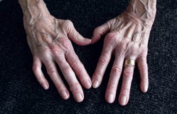 Rheumatica, die Hand der Frau mit den heumatoid Arthritishänden und -fingern seit vierzig Jahr seit erster Diagnose stockfoto Rheumatica, die Hand der Frau mit den heumatoid Arthritishänden und -fingern seit vierzig Jahr seit erster Diagnose stockfoto