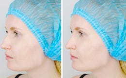 Rhinoplasty: пациент на допущении к пластическому хирургу Она должна пойти через нос стоковое изображение rf Rhinoplasty: пациент на допущении к пластическому хирургу Она должна пойти через нос стоковое изображение rf