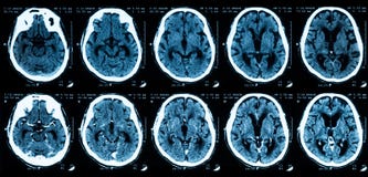 Ricerca di CT del cervello, senza e con mezzi di contrasto immagini stock Ricerca di CT del cervello, senza e con mezzi di contrasto immagini stock