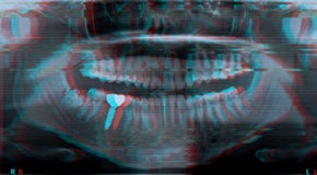 Roentgen teeth upper and lower jaw stock photo Roentgen teeth upper and lower jaw stock photo