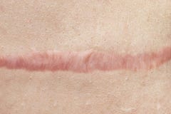 Schlie?en Sie oben von der cyanotic Keloidnarbe, die durch Chirurgie und N?hen, Hautunvollkommenheiten oder Defekte verursacht wi lizenzfreie stockfotografie Schlie?en Sie oben von der cyanotic Keloidnarbe, die durch Chirurgie und N?hen, Hautunvollkommenheiten oder Defekte verursacht wi lizenzfreie stockfotografie