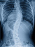 Scoliosis film x-ray show spinal bend in teenager