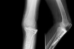 Show image of x-ray both leg and show external fixation of them stock image Show image of x-ray both leg and show external fixation of them stock image
