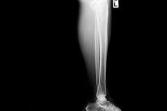 Show image of tibia and fibula left lateral royalty free stock photos Show image of tibia and fibula left lateral royalty free stock photos